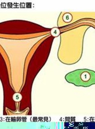 女性子宫内膜异位症会造成不孕吗？