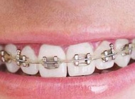 专业医生：孩子牙齿矫正什么时候做最好？