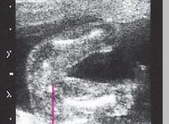 通过超声波图片看到孕10个月的胎儿