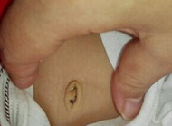 2岁以内宝宝的脐疝是否需要治疗？