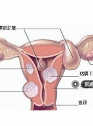 患了子宫肌瘤，也不一定就要切掉