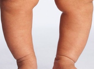 为何宝宝会出现“X”形腿和“O”形腿