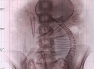 孕期能不能照X光？X光影响胎宝吗？
